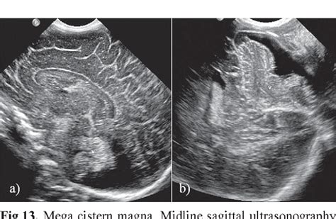 prominent cisterna magna|enlarged cisterna magna in newborn.